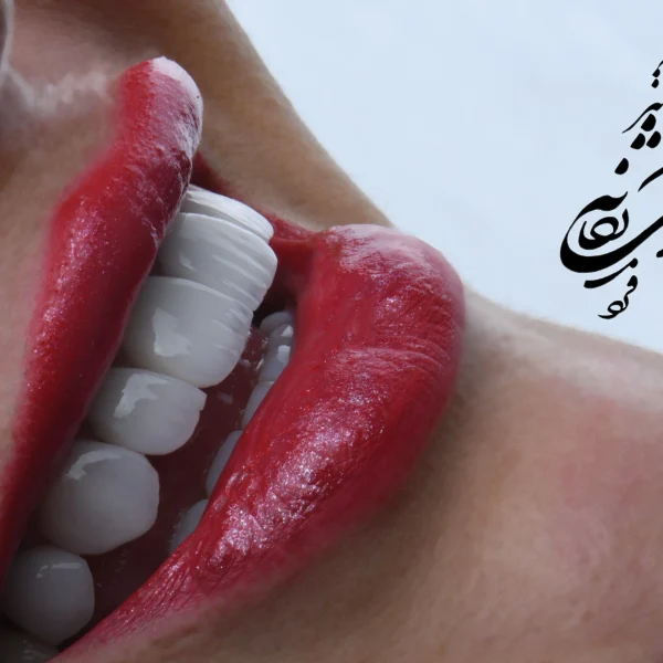 کلینیک دندانپزشکی تی دنتا|دکتر علیرضا تسلیمی و دکتر حدیث یگانه فرد 25 لمینیت دندان "دکتر حدیث یگانه فرد"