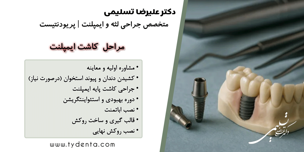 مراحل کاشت ایمپلنت دندان در کلینیک تی‌دنتا در تهران