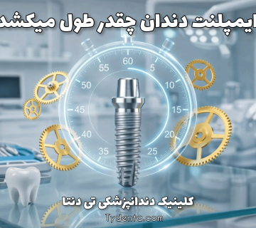 ایمپلنت-دندان-چقدر-طول-میکشد