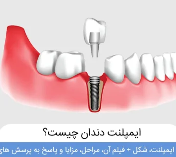 دکتر علیرضا تسلیمی و دکتر حدیث یگانه فرد| بهترین کلینیک ایمپلنت در تهران