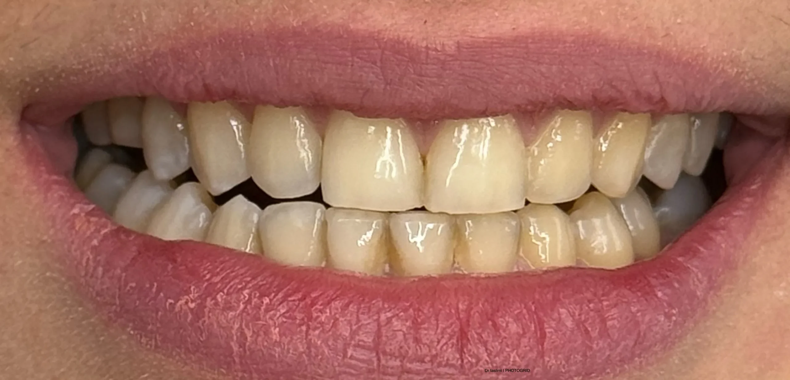 وضعیت دندان‌ها قبل از انجام بلیچینگ
