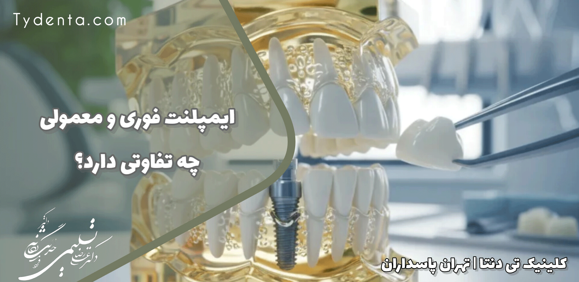 فرق ایمپلنت فوری با معمولی