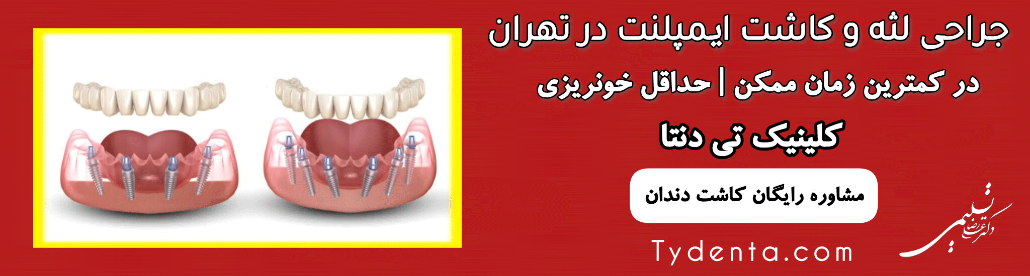 مشاوره رایگان ایمپلنت فوری