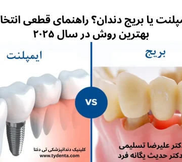 ایمپلنت یا بریج دندان| دکتر علیرضا تسلیمی و دکتر حدیث یگانه فرد