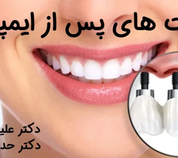 ایمپلنت دندان یکی از بهترین روش‌های جایگزینی دندان‌های ازدست‌رفته است، اما موفقیت این درمان تنها به جراحی وابسته نیست. مراقبت‌های بعد از ایمپلنت دندان نقشی کلیدی در دوام و سلامت ایمپلنت دارند.