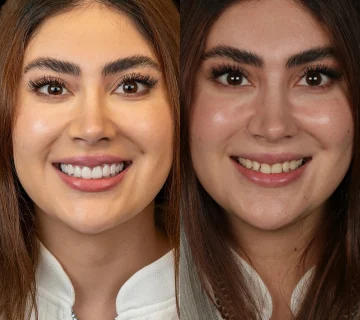 تفاوت کامپوزیت و لمینت دندان؛ مقایسه کامل و انتخاب بهترین روش طراحی لبخند