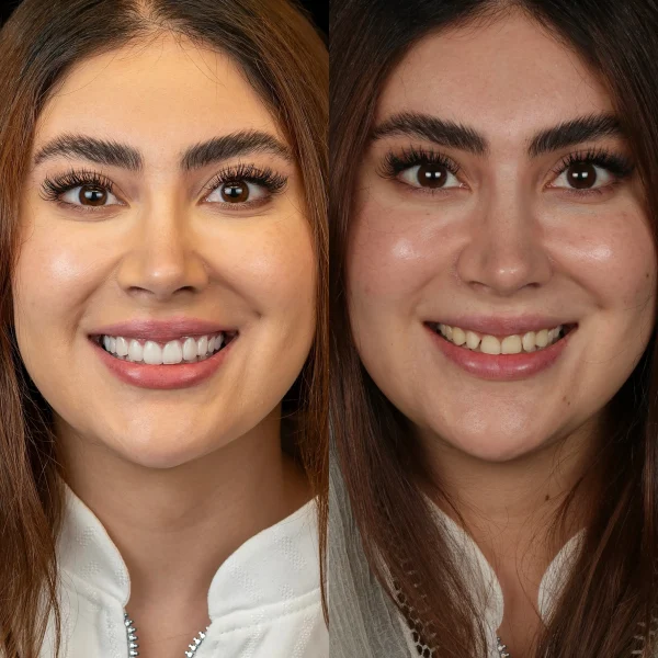 کلینیک دندانپزشکی تی دنتا|دکتر علیرضا تسلیمی و دکتر حدیث یگانه فرد 21 تفاوت کامپوزیت و لمینت دندان؛ مقایسه کامل و انتخاب بهترین روش طراحی لبخند