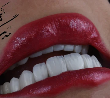 کامپوزیت دندان – راهنمای کامل، مزایا، معایب و بهترین کلینیک در تهران | کلینیک تی دنتا