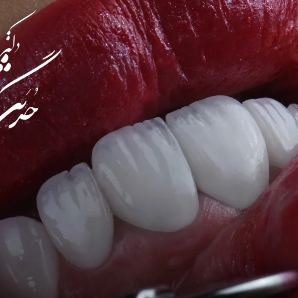 کلینیک دندانپزشکی تی دنتا|دکتر علیرضا تسلیمی و دکتر حدیث یگانه فرد 35 کامپوزیت دندان در تهران| کلینیک تی دنتا