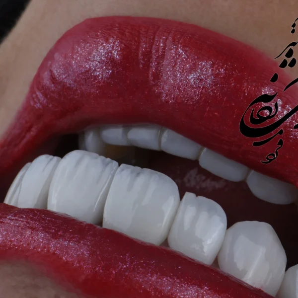 کلینیک دندانپزشکی تی دنتا|دکتر علیرضا تسلیمی و دکتر حدیث یگانه فرد 33 کامپوزیت دندان – راهنمای کامل، مزایا، معایب و بهترین کلینیک در تهران