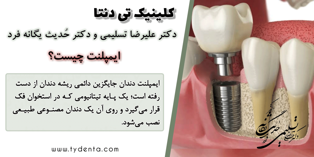 ایمپلنت دندان چیست | بریج بهتر است با ایمپلنت دندان | کلینیک تی دنتا در تهران