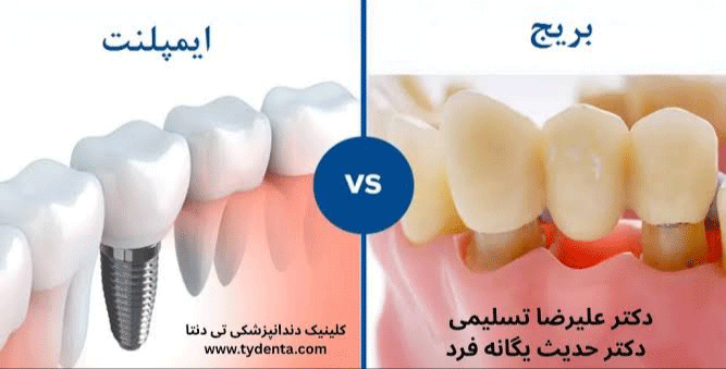 بریج بهتر است یا ایمپلنت دندان؟ |کلینیک تی‌دنتا در تهران | دکتر علیرضا تسلیمی و دکتر حدیث یگانه فرد