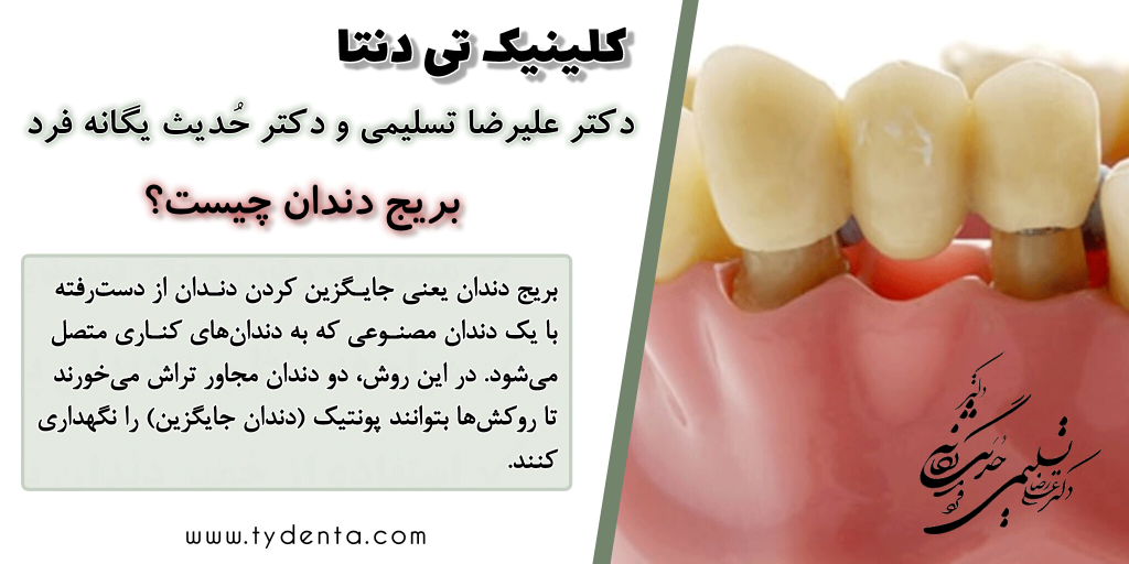 بریج دندان چیست | بریج بهتر است یا ایمپلنت | کلینیک تی‌دنتا- پاسداران