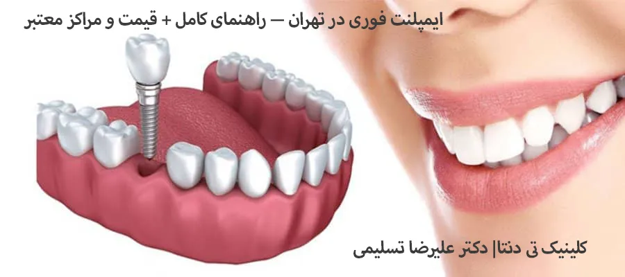 ایمپلنت فوری در تهران| کلینیک تی دنتا