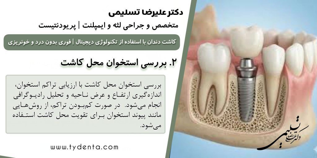 بهترین متخصص ایمپلنت در تهران | دکتر علیرضا تسلیمی | کلینیک تی دنتا