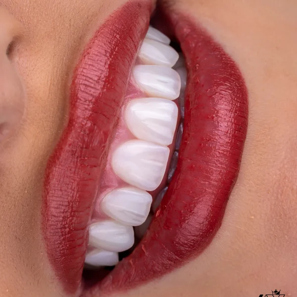 کلینیک دندانپزشکی تی دنتا|دکتر علیرضا تسلیمی و دکتر حدیث یگانه فرد 38 نمونه کار کلینیک دندانپزشکی تی دنتا