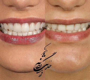 کامپوزیت ونیر " دکتر حدیث یگانه فرد" کلینیک دندانپزشکی تی دنتا