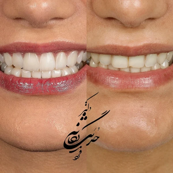 کلینیک دندانپزشکی تی دنتا|دکتر علیرضا تسلیمی و دکتر حدیث یگانه فرد 18 کامپوزیت ونیر " دکتر حدیث یگانه فرد" کلینیک دندانپزشکی تی دنتا