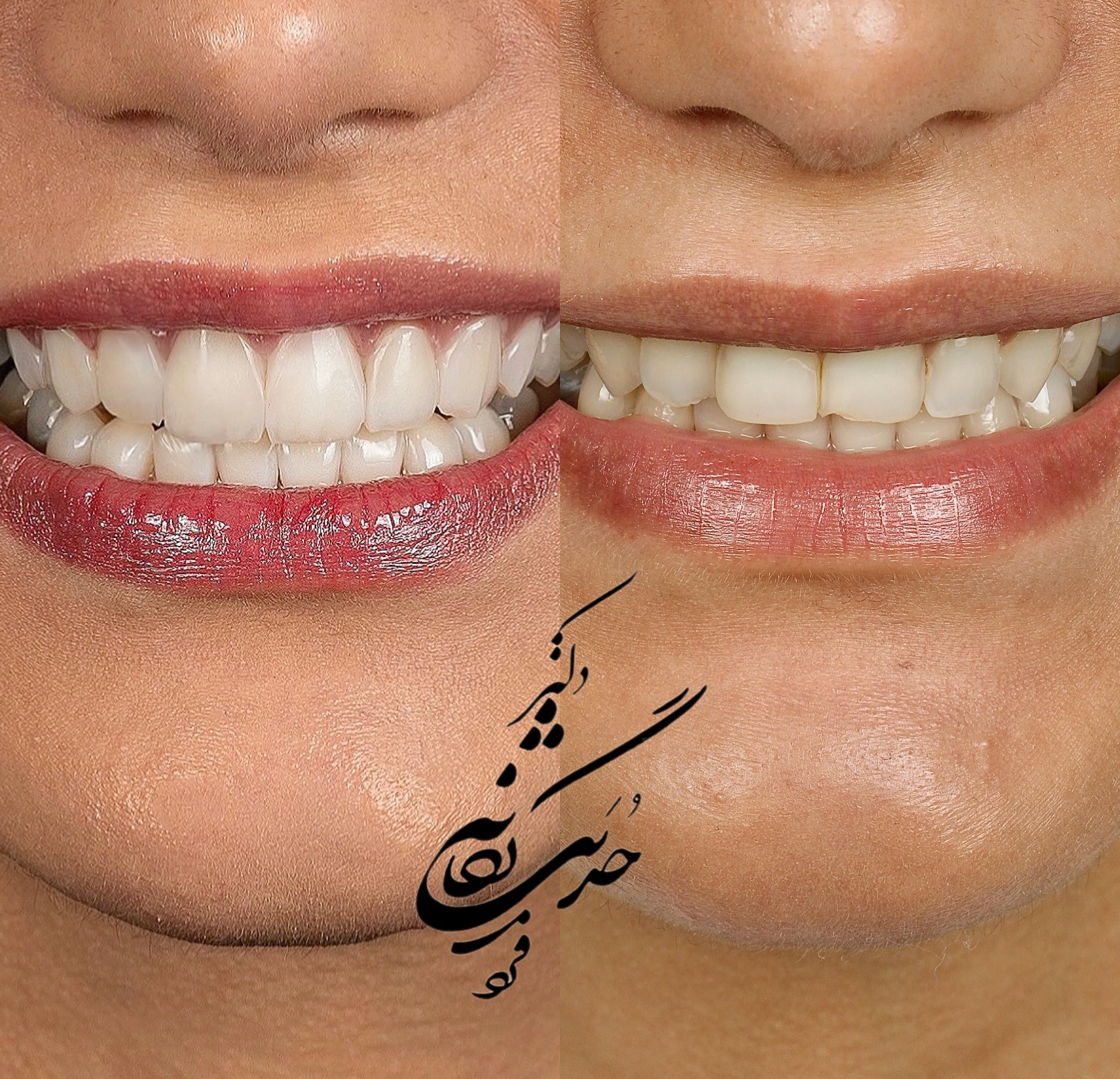 کلینیک دندانپزشکی تی دنتا|دکتر علیرضا تسلیمی و دکتر حدیث یگانه فرد 18 کامپوزیت ونیر " دکتر حدیث یگانه فرد" کلینیک دندانپزشکی تی دنتا