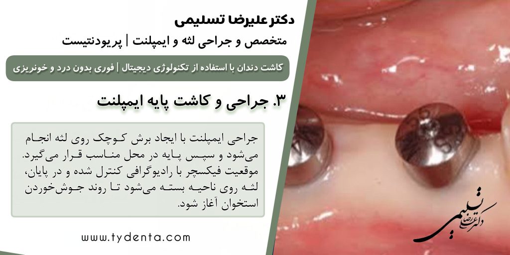 بهترین متخصص ایمپلنت در تهران | دکتر علیرضا تسلیمی | کلینیک تی دنتا
