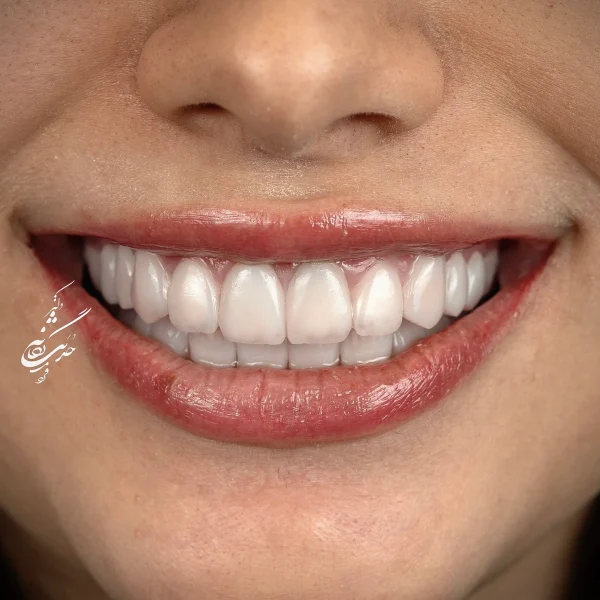 کلینیک دندانپزشکی تی دنتا|دکتر علیرضا تسلیمی و دکتر حدیث یگانه فرد 15 IMG 5993 14 11zon