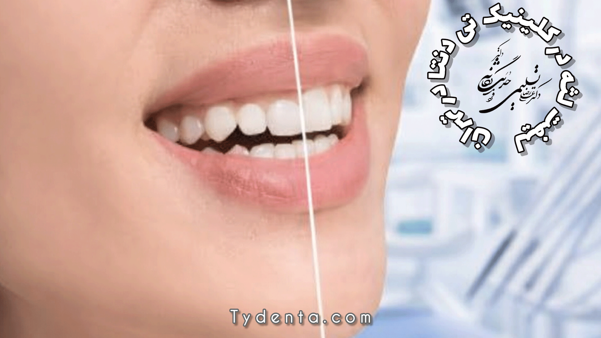 لیفت لثه در تهران | دکتر علیرضا تسلیمی در کلینیک تی دنتا