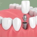 ایمپلنت دندان لترال چیست