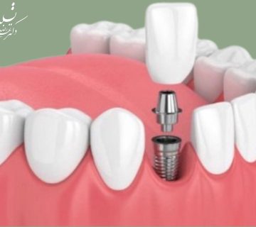 ایمپلنت دندان لترال چیست