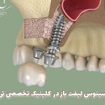 سینوس-لیفت-باز-در-کلینیک-تخصصی-تی-دنتا