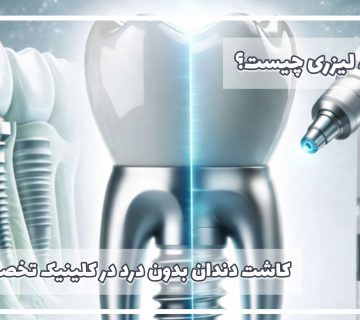 ایمپلنت-لیزری-چیست-ایمپلنت-دندان-با-لیزر