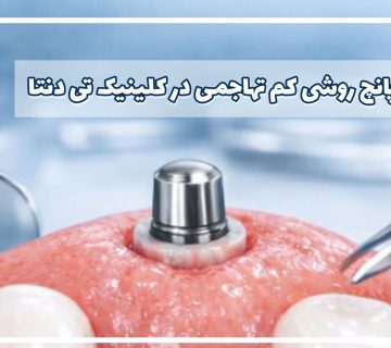 ایمپلنت پانچ روشی کم تهاجمی و بدون برش لثه