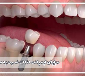مزایای-ایمپلنت-دندان-نسبت-به-سایر-روش‌ها