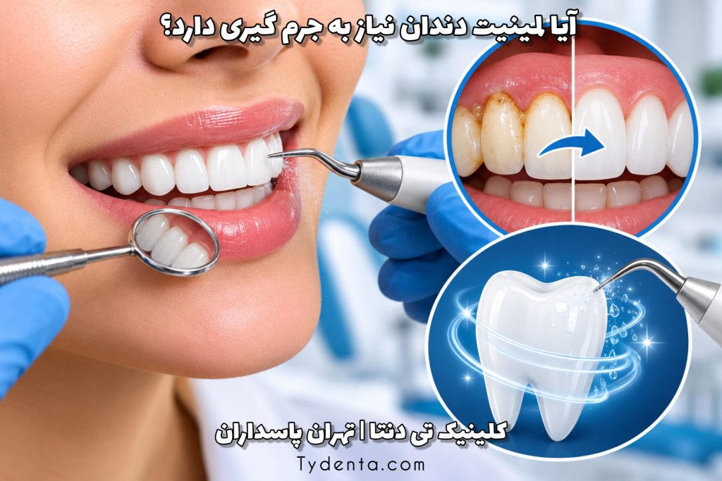 آیا لمینیت دندان نیاز به جرم‌گیری دارد؟